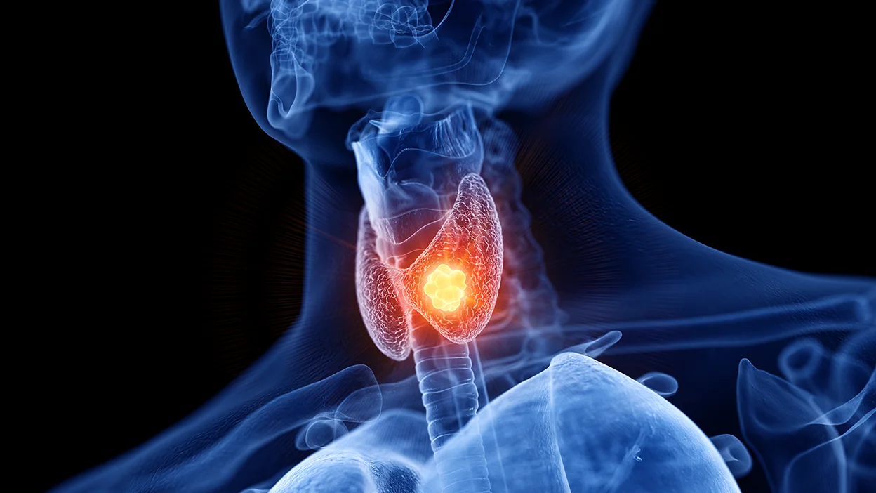 The Role of T3 in Thyroid Treatment